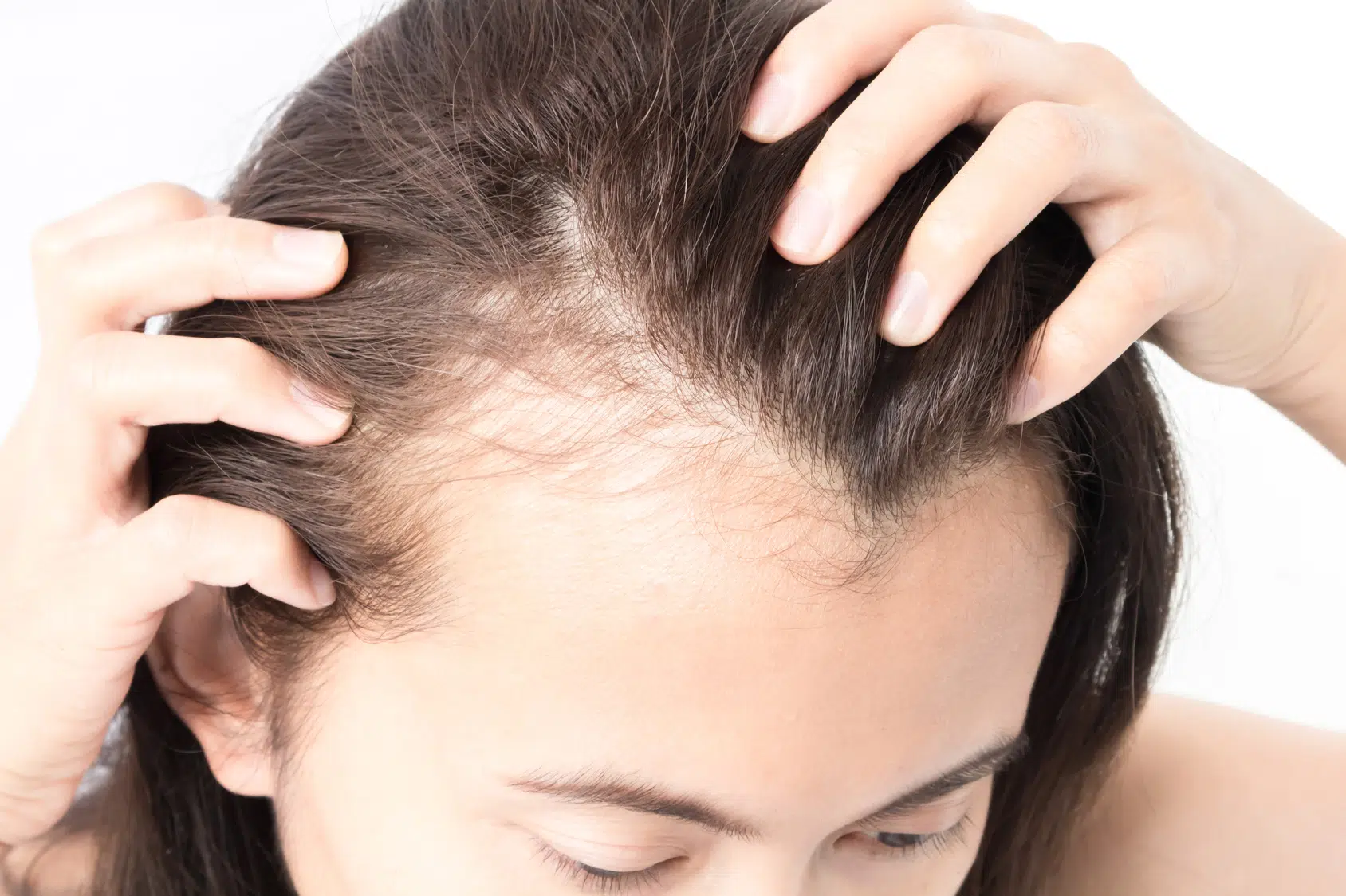 greffe de cheveux