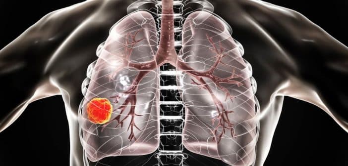 Prises en charges thérapeutiques du cancer du poumon